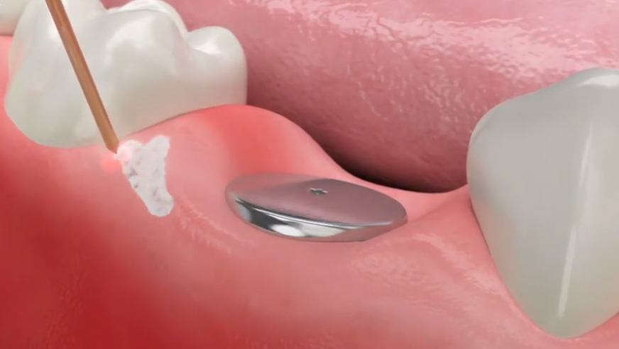 dental implant Cary NC