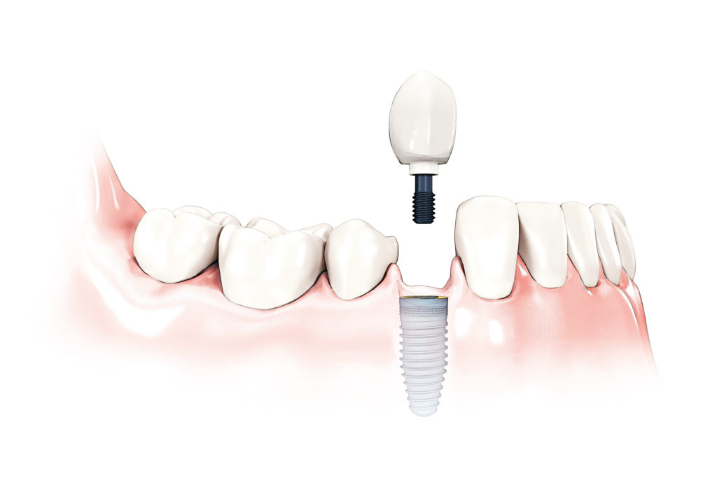 screw retained dental implant model