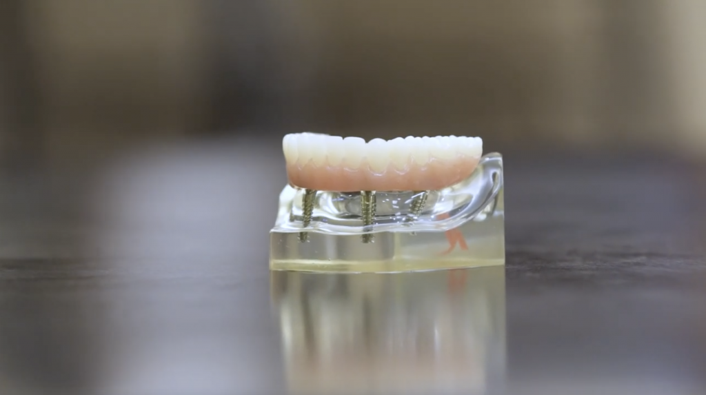 All-on-4 dental implant model